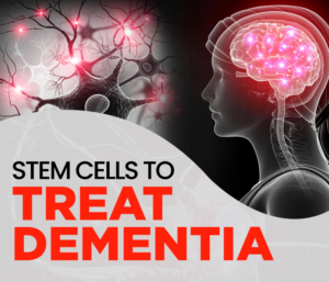 Stem Cells to Treat Dementia